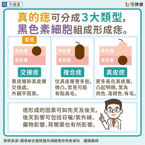 痣變大變凸|是痣or皮膚癌？醫「1張圖秒對照」 長這2部位最危險